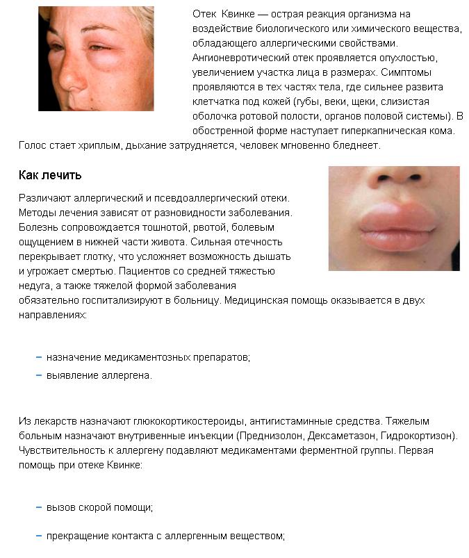Лечение отека Квинке